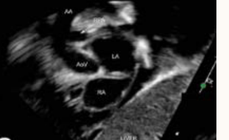 <p>long of the aorta </p>