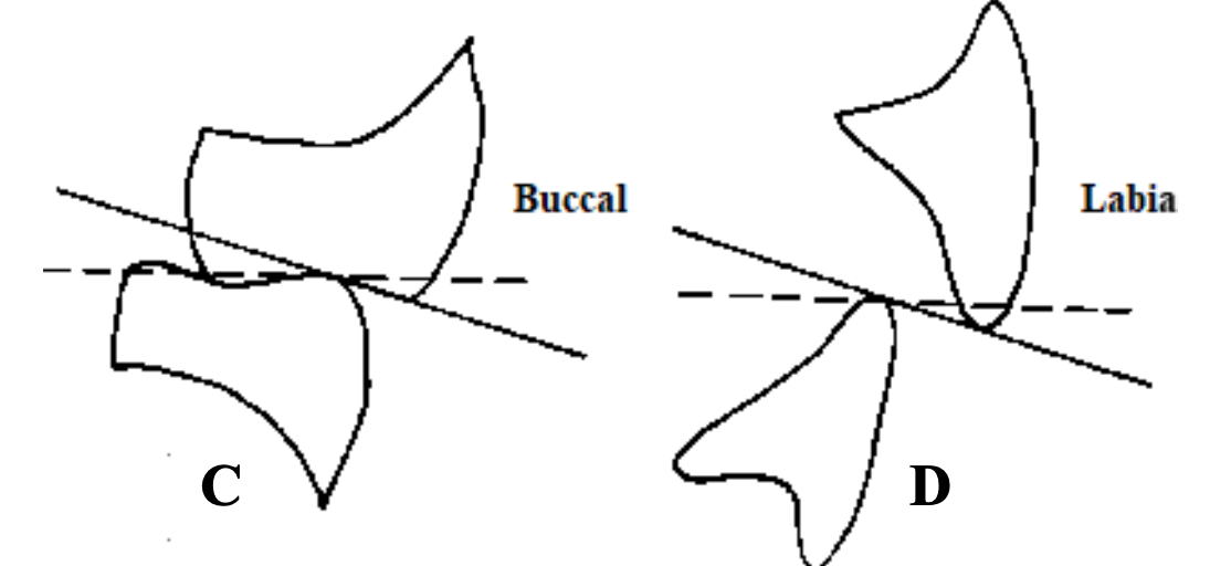<p>In an CD/RPD case, when are nonanatomic teeth used (Dentsply Anatoline)?</p>