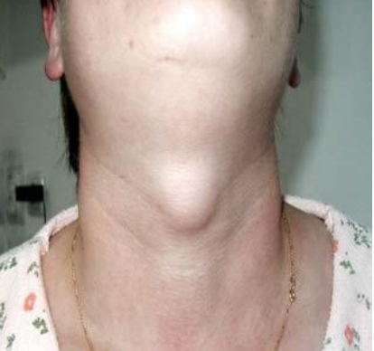 <p>A 45 year old presented with a cystic swelling in midline of the neck. Provide DD</p>