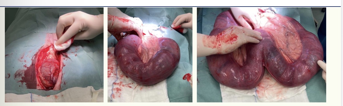 <p>Surgical technique - How to protect abd from uterus </p>