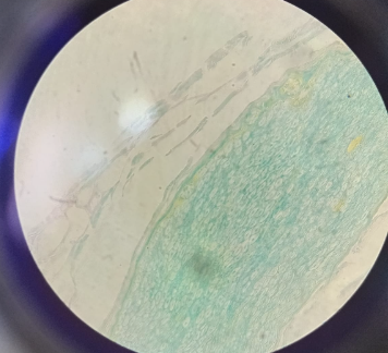<p>Peripheral Nerve - OsO4</p><ul><li><p><strong>Focus:</strong> Used specifically to visualize <strong>myelinated neurons</strong>.</p></li><li><p><strong>Visuals:</strong> The <strong>axon</strong> is in the center, wrapped in a dark/black <strong>myelin sheath</strong>.</p></li><li><p><strong>Connective Tissue:</strong> Also identifies the <strong>endoneurium</strong>, <strong>perineurium</strong>, and <strong>epinurium</strong></p></li></ul><p></p>