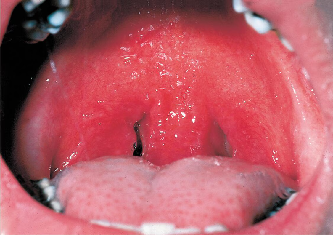 <p>Local inflammation, fever, tonsillitis, enlarged lymph nodes</p>
