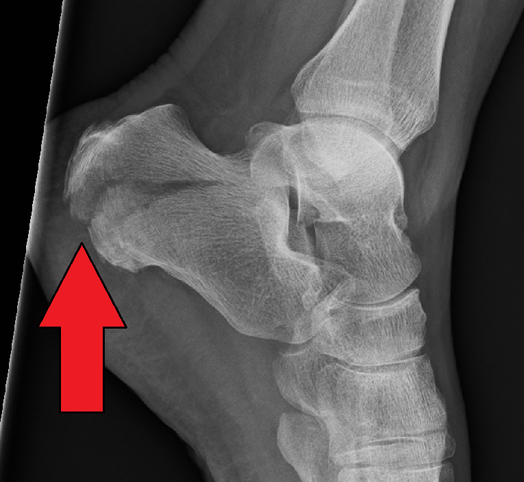 <p>Calcaneal </p>