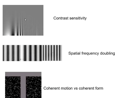 <p>We use tasks that tap into one of the pathways.</p><ul><li><p><span style="background-color: rgb(255, 153, 204); font-family: "Arial Nova Light";">Contrast sensitivity</span><span style="font-family: "Arial Nova Light";"> is how sensitive eye is to black and white contrast at different </span><span style="background-color: rgb(255, 153, 204); font-family: "Arial Nova Light";">spatial frequencies</span><span style="font-family: "Arial Nova Light";"> (something that's high detail is high spatial frequency). Variations tap into the two different pathways. So, dyslexic kids have difficulty with the context sensitivity that is unique to dorsal pathway.</span></p></li><li><p><span style="font-family: "Arial Nova Light";">We also use </span><span style="background-color: rgb(255, 153, 204); font-family: "Arial Nova Light";">coherent motion vs coherent form</span><span style="font-family: "Arial Nova Light";">. Showing dots moving across the screen, we can measure how sensitive they are to it (because dorsal stream is responsible). Less sensitive to it, more likely to have impaired dorsal stream. Have to say in which direction the dots are moving (what is your </span><span style="background-color: rgb(255, 153, 204); font-family: "Arial Nova Light";">psychophysical threshold</span><span style="font-family: "Arial Nova Light";">, they're all moving randomly, but a group are moving in one direction, if you're highly sensitive you only need a few to see movement, if you're not sensitive you'd need a lot to say they're moving in a direction). Normal is 15 -20% of the dots moving coherently, dyslexia would need 80%- thresholds.</span></p></li><li><p><span style="font-family: "Arial Nova Light";">And tasks show no problem with ventral stream.</span></p></li></ul><p></p>