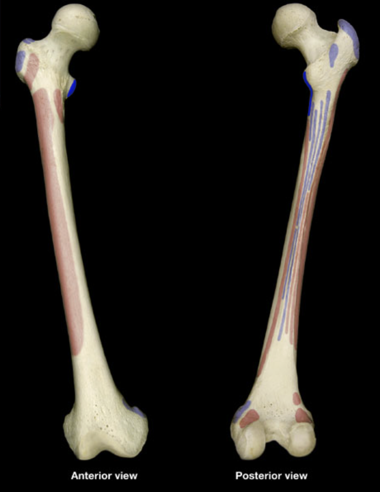 <p>lesser trochanter of femur</p>