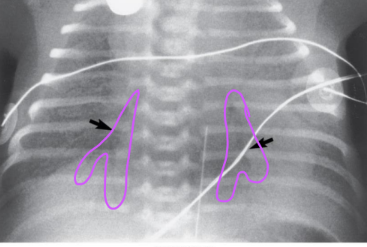 <p>Air bronchogram (spiderweb air pocket)</p>