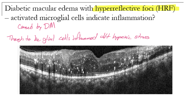 <p>HRF correspond to activated microglial cells, indicating retinal inflammation.</p>