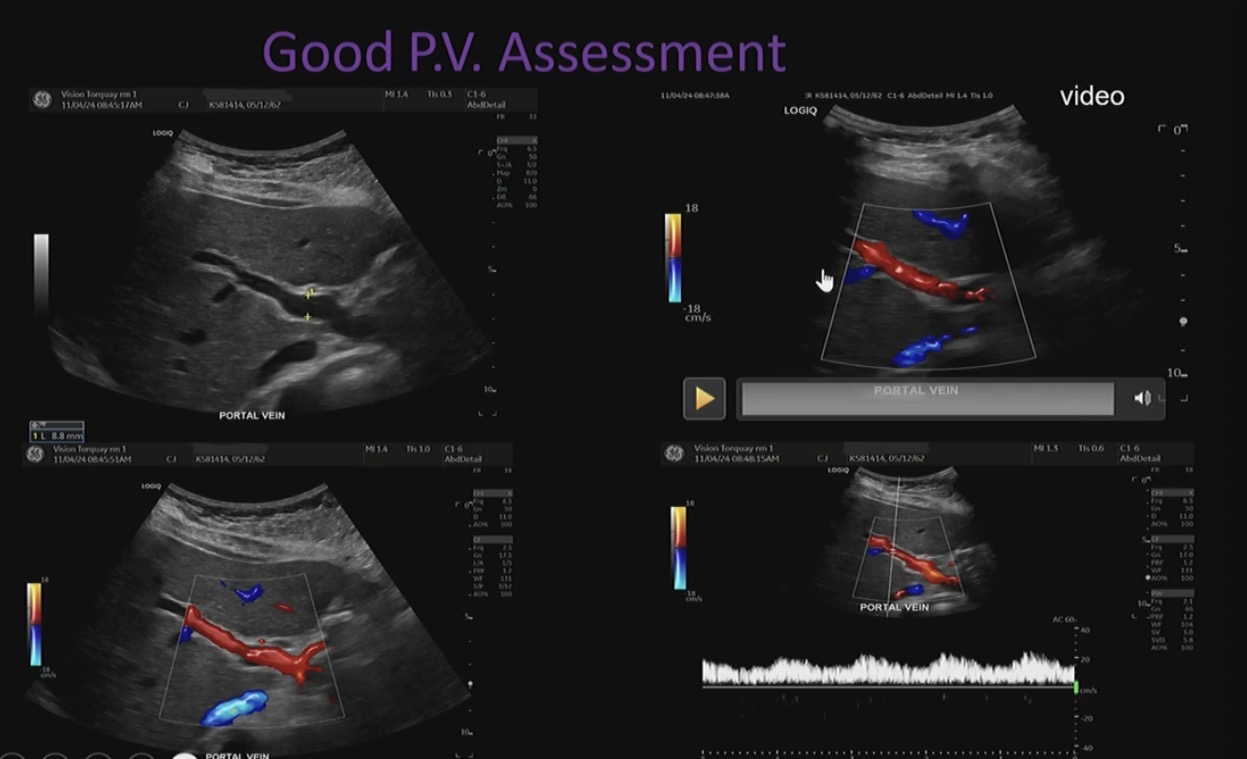 <p>Checking for thrombosis, or enlargement of vessel paired with Doppler trace.</p><p>Uniformity of colour in the vessel.</p>