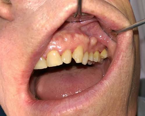 <ul><li><p>General term for extra bone </p></li></ul><p></p>