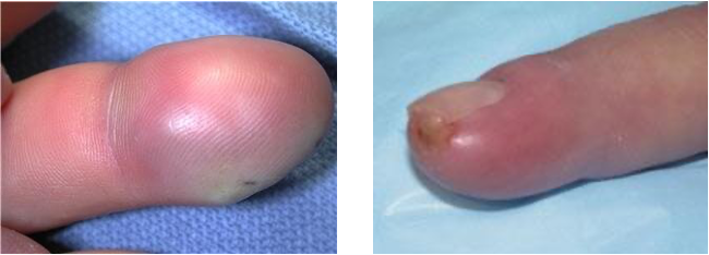 <p></p><ul><li><p>Collection of infectious fluid in the fingertip (have compartments that become filled) </p></li><li><p>Treatment</p><ul><li><p>Incision and drainage</p><ul><li><p>Incision made on one or both sides of the fingertip</p></li><li><p>Break up the compartments</p></li><li><p>Gauze will be placed into the wound to aid the initial drainage</p></li><li><p>Flush out with a sterile solution</p></li></ul></li><li><p>Antibiotics</p></li></ul></li></ul><p></p>