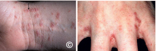 <p>Pruritic papules, vesicles, or burrow lesions found frequently between toes/fingers, palms, and genital areas.</p><p>Symptoms may take 3 to 6 weeks to appear if someone has never had scabies prior</p><p>Diagnosis: Skin scrapings evaluated on a wet mount</p>