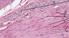 <p>What is indicated by the arrows labeled 'B' in this slide of colon?</p>