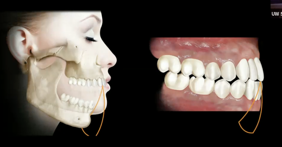 <ul><li><p>anterior guidance </p></li><li><p>condyle guidance </p></li></ul><p></p>
