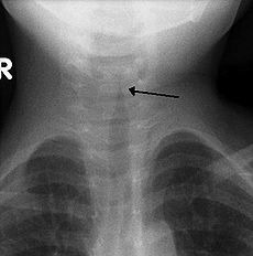 <p>diagnostic finding of ?</p>