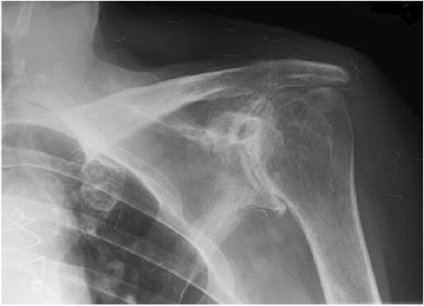 <p>Frozen shoulder is a <strong>progressive disorder</strong> of the glenohumeral joint where the <strong>joint capsule contracts, thickens, and forms adhesions</strong>, severely restricting both <strong>active and passive range of motion</strong></p>