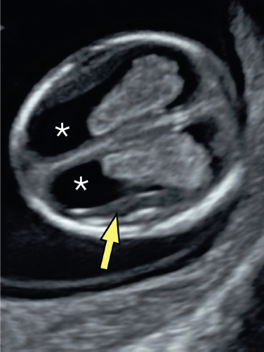 <p>10. What do the “ <strong>* </strong>” in Figure 23-33 indicate?</p><p></p><p>a. Choroid plexus</p><p>b. Lateral ventricles</p><p>c. Cebocephaly</p><p>d. Anencephaly</p>