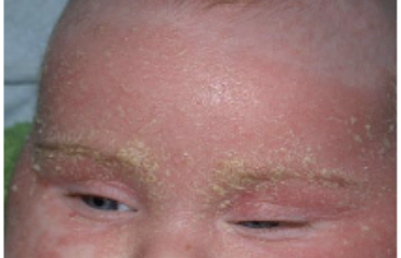 <p>Es una dermatosis eritoescamosa de evolución crónica y recurrente que afecta a niños y adultos, se localiza en piel cabelluda, cara, regiones esternal o interescapular y pliegues </p>