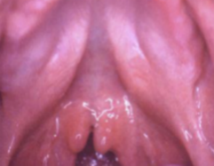 <ol start="8"><li><p>Identify the finding shown.</p></li></ol><p></p>