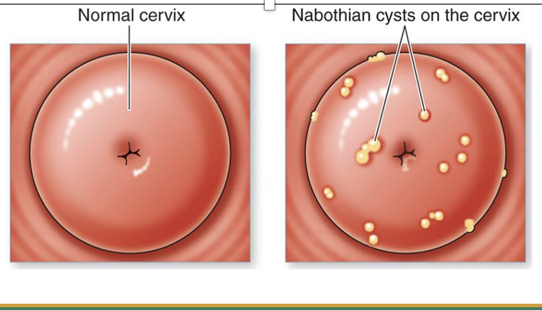 <p><span>Nabothian cysts</span></p>