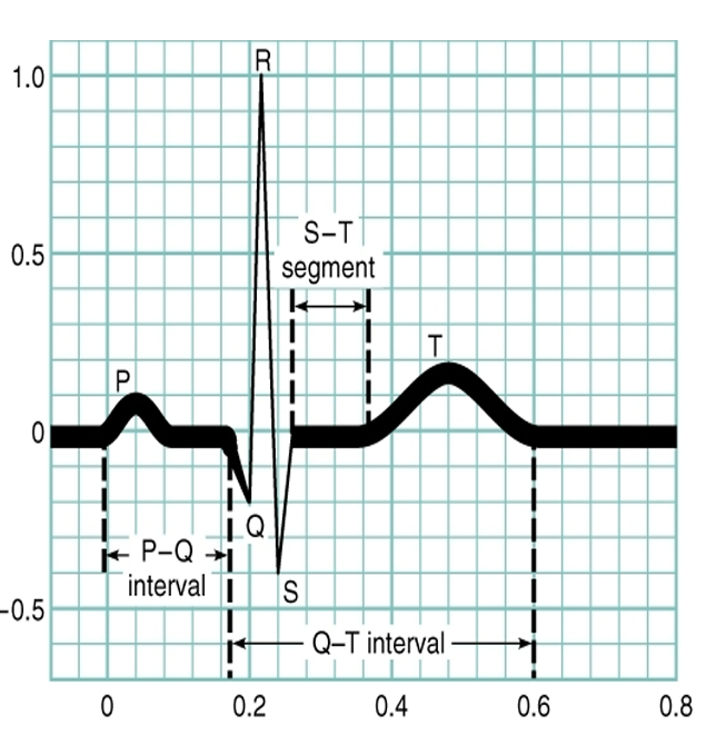 <p>Graphic representation of the electrical events</p><p>•P wave – atrial depolarization (blood intro ventricles)</p><p>•QRS complex – Ventricular depolarization (push blood out of body to lungs)</p><p>•T wave – ventricular repolarization (ventricles fill with blood, relaxing “reset” phase)</p><p>What of atrial repolarization? —> none, no wave on the EKG that represents this</p>