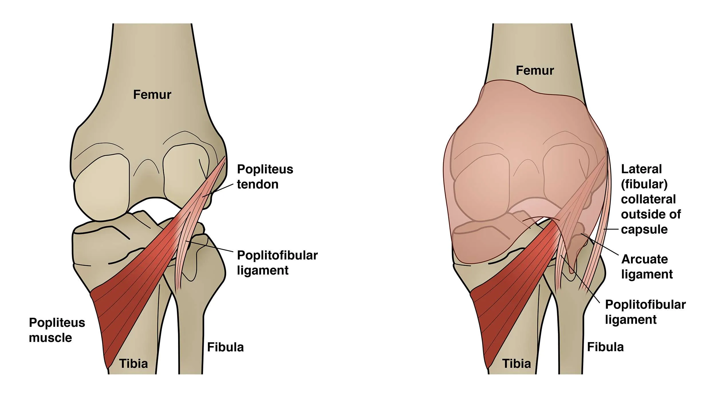 <p>Addressed during lateral soft-tissue balancing.</p>