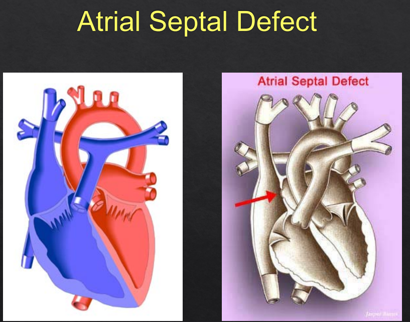 <p>Simple Acyanotic CHD</p><p><strong>RF</strong>: chromosomal assoc. (Downs Syndrome etc)</p><p><strong>Sx</strong>: Cough, noisy breathing/breathing difficulties, swelling/oedema, failure to thrive/LOW, short stature, crying/irritable/unwell, dysmorphic features, newborn resp. distress</p><ul><li><p>Often minimal sx until adulthood (acyanotic)</p></li></ul><p><strong><u>Ix</u></strong>:</p><p><strong>First Line</strong>: Clinical Exam, CXR (enlarged right heart/pulmonary artery)</p><p><strong>Gold Standard</strong>: Echocardiograph (size, shunt volume, global cardiac function etc)</p>
