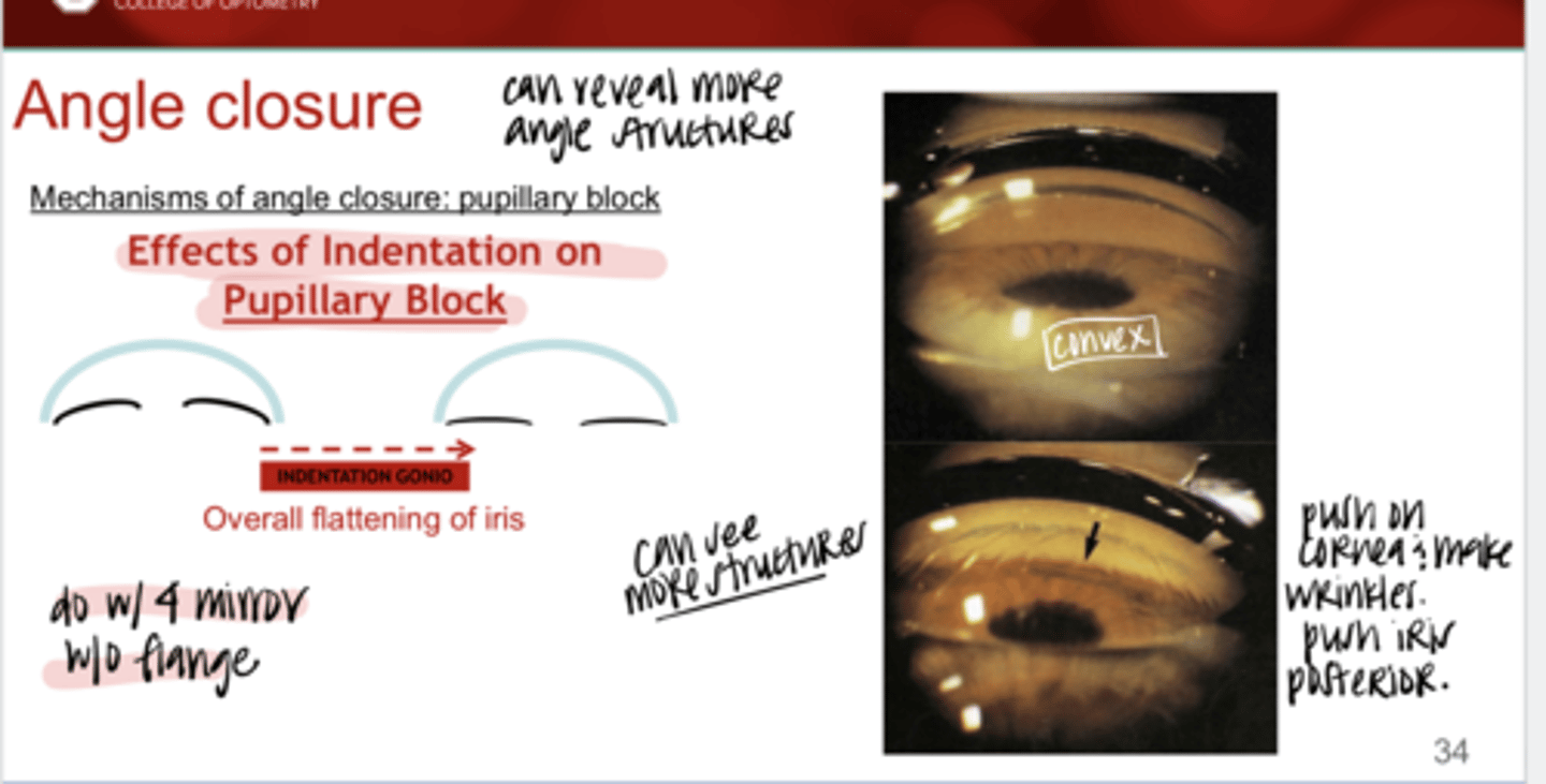 <p>How to perform indentation gonioscopy w/ angle closure?</p>