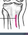 <p>anterior medial condyle of tibia</p>