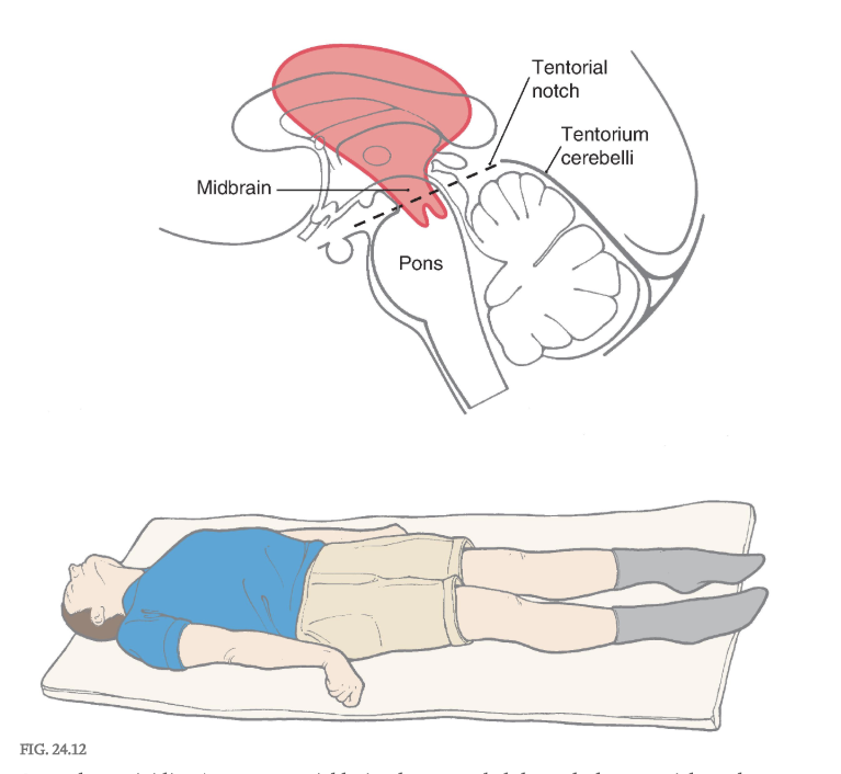 <p>Decerebrate rigidity. A supratentorial lesion has extended through the tentorial notch. The patient’s lower extremities are extended, with the toes pointed inward; the upper extremity is extended, with the fingers flexed and the forearms pronated; and the neck and head are extended. The rigidity may be so extreme that the patient’s back is arched up off the bed. A patient may become decerebrate after a period of decorticate posturing (see Fig. 24.15 ).</p><p></p><p>In this situation, all descending cortical systems are interrupted, including the corticospinal tract as well as the corticorubral and corticoreticular projections. In addition, the red nucleus and rubrospinal tract are damaged. However, the vestibulospinal system, which lacks a cortical projection, remains intact. Similarly, the cells of origin for the excitatory and inhibitory components of the reticular formation lie caudal to the level of the lesion, thus both pontine and medullary reticulospinal projections remain intact ( Fig. 24.9 and 24.10 ), although they have lost their excitatory cortical input. Importantly, the ascending nociceptive input from the anterolateral system that is preferentially directed to the pontine elements of the reticular formation remains intact, and thus the excitatory component of the reticulospinal system remains functional. Conversely, the inhibitory reticulospinal component from the medulla is rendered nonfunctional because it is left with no significant excitatory drive. Consequently, a noxious stimulus delivered to a decerebrate patient may activate the excitatory reticulospinal system and exacerbate decerebrate rigidity that is already present or evoke decerebrate posturing when it is otherwise not apparent.</p><p><strong>Central </strong>(or <strong>transtentorial </strong>) <strong>herniation </strong>may be seen in patients with large tumors in the hemisphere or after a large hemorrhage in the hemisphere ( Figs. 24.11 and 24.12 ). In the diencephalic stage (before herniation through the tentorial notch), the patient may have a decreased level of consciousness, lethargy, small but poorly reactive pupils, and eye movement disorders. In addition, the <strong>withdrawal reflex </strong>to noxious stimuli is intact, reflexes are hyperactive, and there is a bilateral Babinski response. Once the herniation occurs, there is a rapid decline. The patient exhibits decerebrate posture, ( Fig. 24.12 ) is comatose, has dilated and fixed (do not react to light) pupils, and eye movement is absent. As the damage extends downward through the midbrain, respiration is compromised ( <strong>Cheyne-Stokes, tachypnea, </strong>followed by shallow rapid rates), and survival is highly unlikely.</p>
