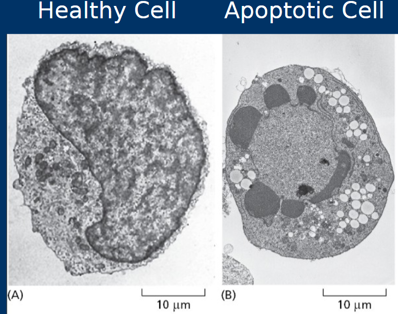 <p><span style="color: rgb(0, 0, 0);"><span>Cell death by</span><strong><span> apoptosis</span></strong><span><br></span><span>• Highly regulated –“Programmed cell death”</span><span><br></span><span>• Membrane “blebs” enclose cell components for</span><strong><span> phagocytosis</span></strong><span><br></span><span>• Organized to prevent inflammation</span></span></p><p><span style="color: rgb(0, 0, 0);"><span>• During </span><strong><span>apoptosis</span></strong><span> cells shrink and cell membranes undergo “blebbing”</span></span></p><p><span style="color: rgb(0, 0, 0);"><span>*</span></span><span><span>Apoptosis is regulated by pro- and anti-apoptotic factors</span></span></p>