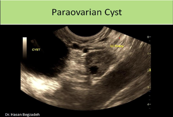<p>D. Morgagni or mesonephric cyst</p><p>Paraovarian cysts arise from the tissues of the broad ligament, composed of predominantly mesothelium. They can also form paramesonephric cysts AKA Mullerian cysts and mesonephric or fallopian tube remnants (mesonephric cyst or Wolffian cyst). A hydatid cyst of Morgagni is an acquired cyst of the broad ligament. A Gartner duct cyst is located in the vaginal tract.</p>