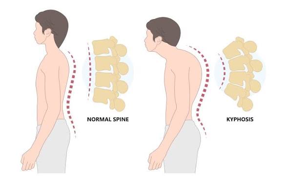 <p>Kyphosis (hunchback)</p>