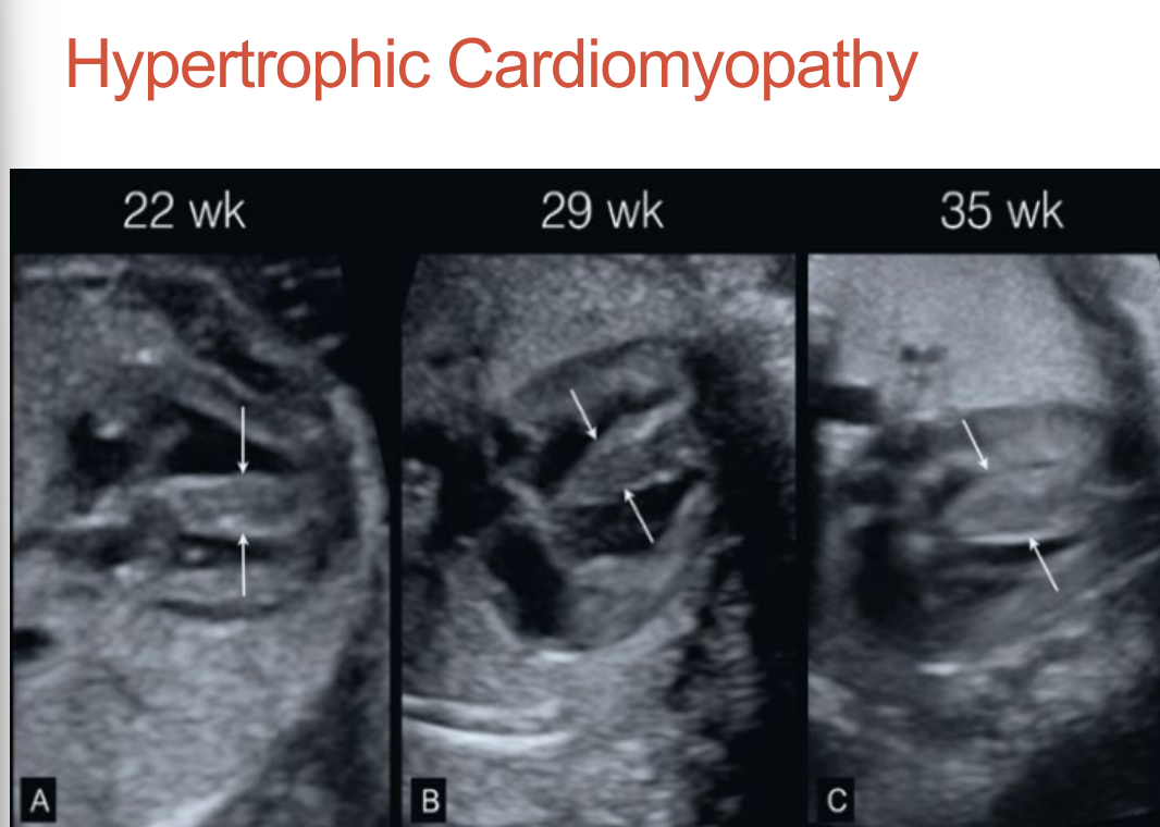 <p>Concentric hypertrophy of both ventricles • </p><p>Small ventricular chamber size with normal function •</p><p> Left ventricular outflow track obstruction can occur • </p><p>Pericardial effusion is common • </p><p>May be caused by diabetes, storage diseases, and Noonan Syndrome • </p><p>Can resolve or lead to heart failure, hydrops, and in utero death</p>