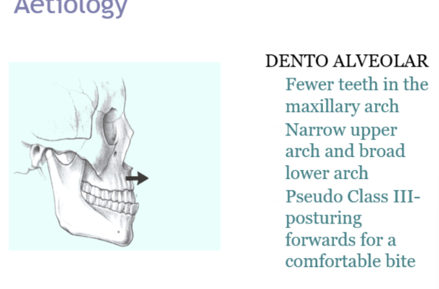 <p>e.g hypodontia where there is a reduced upper arch length</p><ul><li><p>Fewer teeth in the maxillary arch</p></li><li><p>Narrow upper arch and broad lower arch</p></li><li><p>pseudo class 3 posturing forwards for a comfortable bite</p></li></ul><p></p>