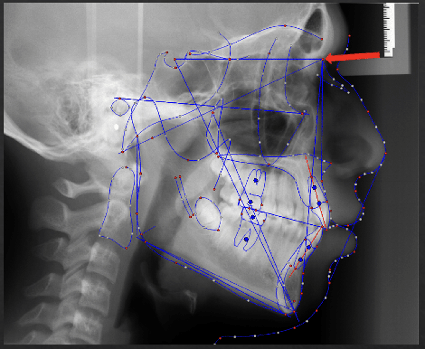 <p>which anatomical landmark:</p><p>- The most anterior point of the intersection between the nasal bone and the frontal bone</p>