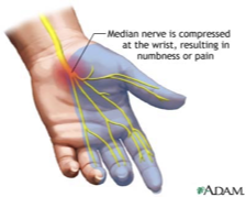 <ul><li><p>Compression of the median nerve as it passes through the carpal tunnel</p><ul><li><p>Transverse carpal ligament</p></li><li><p>Pulls inward and compresses the median nerve underneath</p></li></ul></li><li><p>Causes</p><ul><li><p>Diabetes</p></li><li><p>Hypothyroidism</p></li><li><p>Obesity</p></li><li><p>Pregnancy (retention of fluid)</p></li><li><p>Overuse/compression (typing)</p></li><li><p>Masses</p></li></ul></li><li><p>Presentation</p><ul><li><p>Numbness, tingling, pain</p><ul><li><p>Thumb, index, middle and radial border of ring finger</p></li></ul></li><li><p>Night pain</p></li><li><p>Weakness of abductor pollicis brevis</p></li><li><p>Thenar atrophy</p><ul><li><p>Impaired thenar innervation due to chronic median nerve compression, if left untreated, can lead to thenar atrophy</p></li><li><p>Will have permanent deficit</p></li></ul></li><li><p>Act on sensory issues before motor issues become a problem</p></li></ul></li><li><p>Diagnosis → clinical</p></li><li><p>Treatment</p><ul><li><p>Conservative</p><ul><li><p>Braces/splints</p></li><li><p>PT/OT</p></li><li><p>+/- NSAIDs</p></li><li><p>+/- PO corticosteroids (Medrol packs: can cause high BGL in diabetics and cause SVT)</p></li><li><p>Cortisone injections with</p></li></ul></li><li><p>Surgical</p><ul><li><p>Carpal tunnel release</p><ul><li><p>Can be open vs endoscopic</p></li><li><p>Place blade to slice the ligament and unroofs it to give the median nerve more room </p></li></ul></li></ul></li></ul></li></ul><p></p>