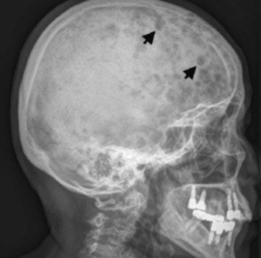 <p>What form of Mets is this?</p><p>- Moth-eaten permeative</p><p>- Male: Lungs</p><p>- Female: Breast</p>
