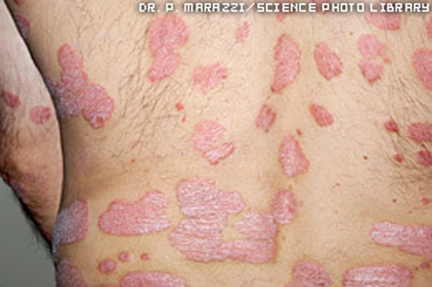 <p>plaquey, silvery</p><p>-lesions from plaque</p><p>-affect scalp, extensor surfaces of elbows, knees, umbilicus, and glueteal cleft</p>