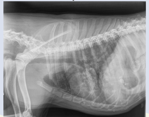 <p>- bronchopneumonia with pre-existing pleural effusion</p><p>- the lung has no well-defined margin</p>