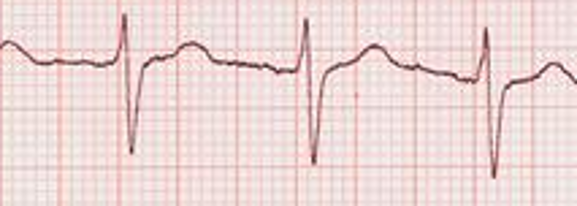 <p>Measures electrical activity of the heart. All muscles have electrical activity and can be measured similarly. Measures heart rate, heart rate variability, and oscillatory change in heart rate across time</p>