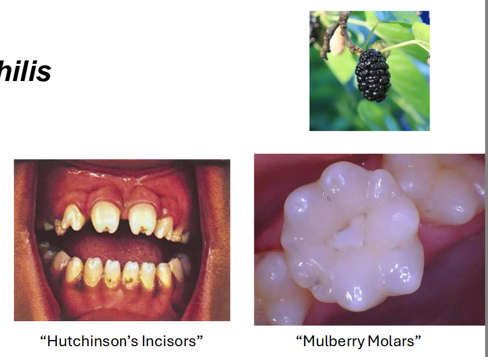 <p>Pathology: Anomalies/ Congenital Disease Example: Congenital syphilis</p>