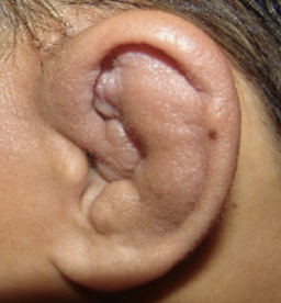 <p><span style="line-height: 20.5042px;"><em>Repeated episodes of blunt trauma. Untreated hematoma. caused by fibrocartilage overgrowth that occurs when an auricular hematoma is not fully drained, recurs, or is left untreated.</em>&nbsp;</span><span style="background-color: rgba(0, 0, 0, 0); line-height: 20.5042px;"><em>May cause EAC narrowing.&nbsp;</em></span></p>