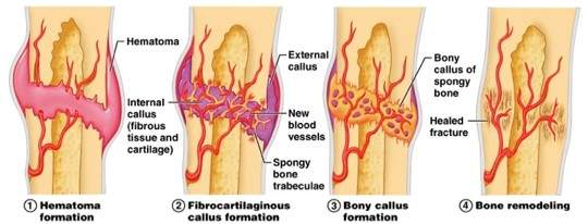<ol><li><p>Haematoma - After impact, bone fragments cause damage to surrounding tissue - haematoma formation - collection of blood outside blood vessels</p></li><li><p>Inflammation - Haematoma replaced by granulation tissue, osteoblasts and stem cells. Migrate into fracture gap (esp. around periosteum), new blood vessels migrate to area and medullary cavity</p></li><li><p>Callus - Tissue formed. Consists fibrous tissue, cartilage, immature bone, increasing density of tissue in area and stabilising to fracture site</p></li><li><p>Bone Infiltration - As bone heals, amount of fibrous tissue decreases, bone and cartilage increase to provide greater stability. Chondroclasts resorb cartilage within callus, osteoblasts line surfaces with new bone to create mineralised matrix</p></li><li><p>Clinical union - Bone fragements become rigidly united by callus. Typically 12-16 weeks in adult cat/dogs with fractures in young animals healing more quickly</p></li><li><p>Remodelling - When bone stabilises, callus remodels, replaced by new, more organised bone. Can take years</p></li><li><p>Incomplete healing</p></li></ol><p></p>