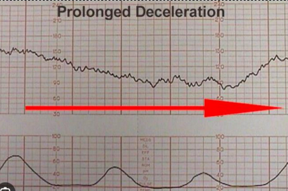 <p>sustained drop in HR, <span style="line-height: 20.85px;"><span>may indicate </span></span><span style="line-height: 23.1667px;"><u><span>cord compression</span></u></span><span style="line-height: 20.85px;"><span> or maternal </span></span><span style="line-height: 23.1667px;"><u><span>HoTN</span></u></span></p>