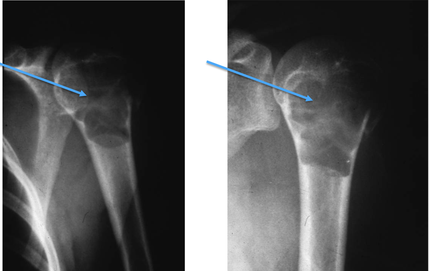 <p>What bone tumour is this, what bone is it in and what can be seen?</p>