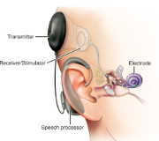 <p>Coclear Implants </p>