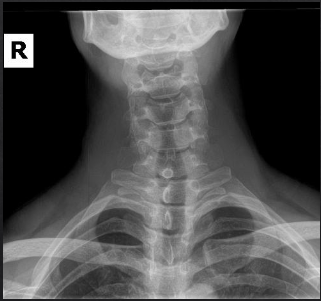 <p>Is this film of diagnostic quality (AP Lower Cervical)</p>