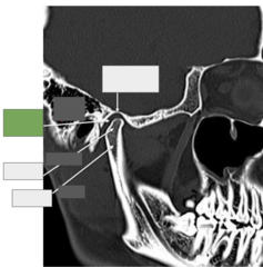 <p>TMJ: This is the</p>