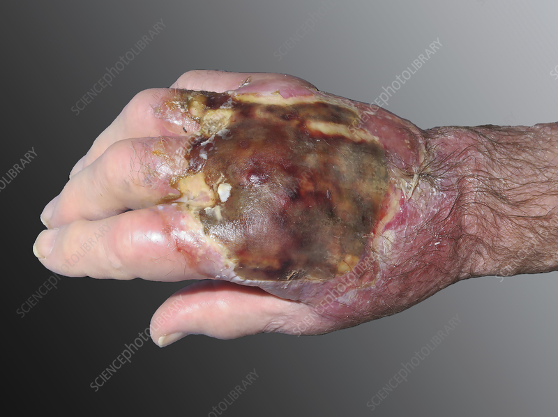 <ol><li><p>destroys <span style="color: rgb(199, 76, 76);"><strong>epidermis, dermis</strong></span> layer</p></li><li><p>may <span style="color: rgb(130, 34, 198);"><strong>damage nerves, bones, muscle</strong> (doesnt feel any pain)</span></p></li><li><p><span style="color: rgb(51, 170, 168);"><strong>eschar </strong></span>visible (thick black tissue)</p></li></ol><p></p>