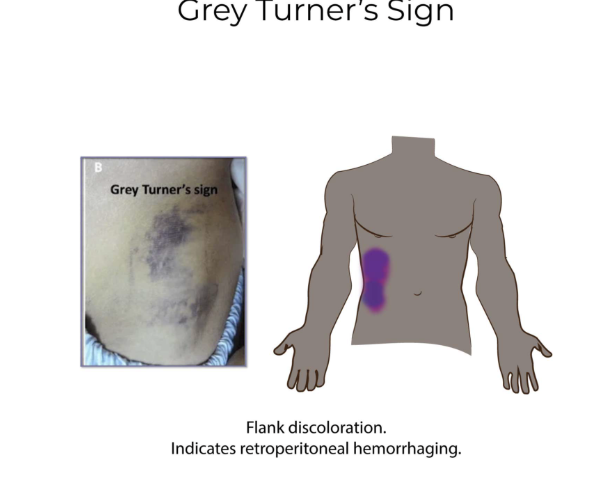 <p>Bruising/flank discoloration from internal abdominal bleeding or pancreatitis</p>